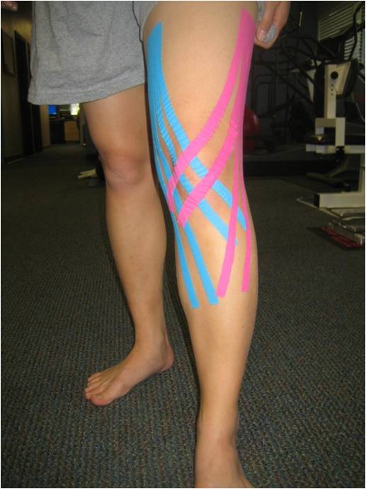 Kinesio Taping® – What is it and what does it do?