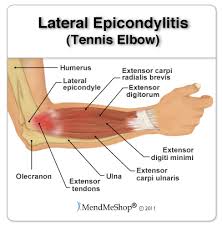 Lateral-Epicondylitis