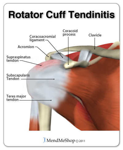 rotator-cuff-supraspinatus-tendonitis